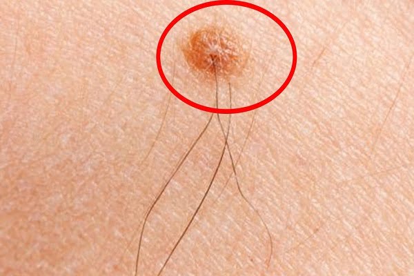 Nốt ruồi có lông trên cơ thể