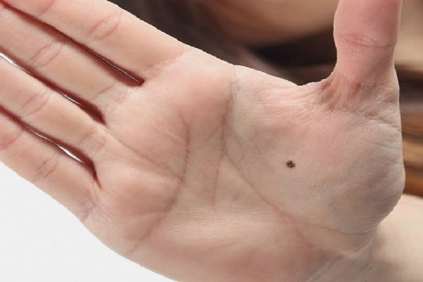 Nốt ruồi trong lòng bàn tay trái – phải nam nữ có ý nghĩa gì?