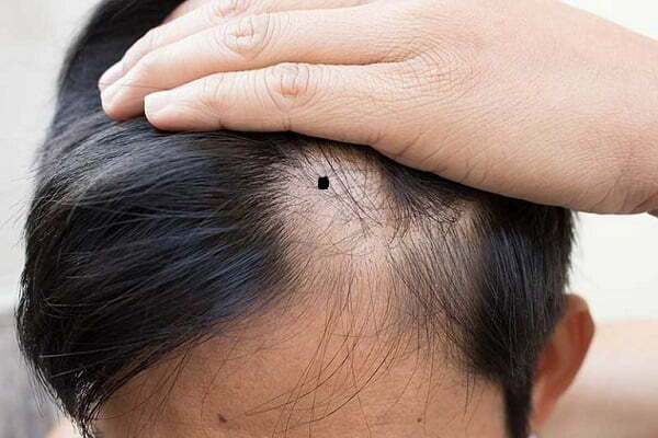 Xem bói nốt ruồi trong tóc Trái Phải Nam Nữ Tốt Xấu