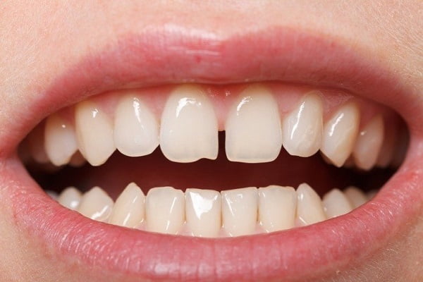 Người răng thưa là người như thế nào? Vận số sướng hay khổ